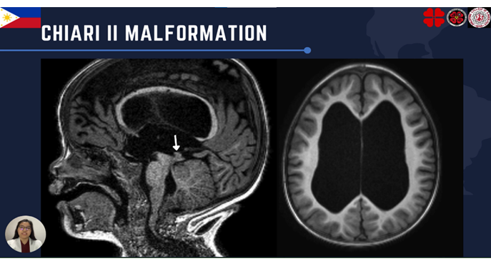 Chiari II malformation